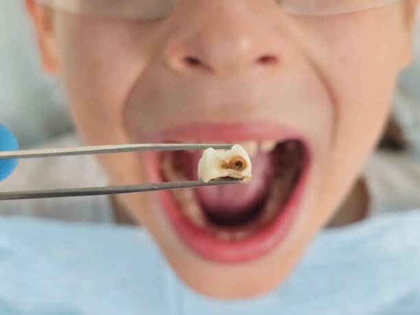 Best Broken or Chipped Tooth Repair in Lanark, IL